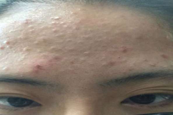 闭口会慢慢自己消失吗