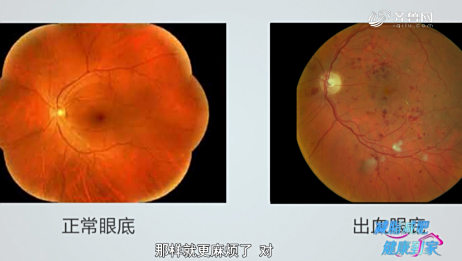 身体健康 糖尿病为什么会导致眼底出血 爱言情