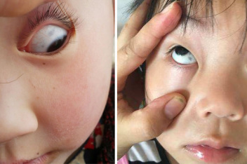 老年斑点 眼白色素斑连着血丝★媒体报道★_百度视频搜索