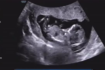 怀孕14周胎儿性别图 百度视频搜索