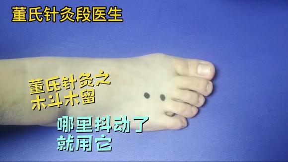 董氏针灸之木斗木留,身体哪个部位抖动了就用它,效果不错