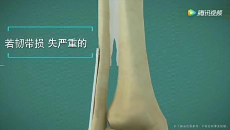 小孩胳膊肘骨折手术后4周钢钉的地方还没消肿还有点硬请问正常吗 相关视频 骨折后钢钉上在哪个位置3d动画让你看懂肘关节损伤手术的原理 爱言情 小孩胳膊肘骨折手术后4周钢钉的地方还没消肿还有点硬请问正常吗 相关视频 骨折后钢钉上在哪个位置3d动画让你看懂肘关节损伤手术的原理 爱言情