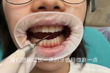 打磨牙齿_百度视频搜索