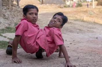 印度一女子产下双头连体婴儿是资讯类高清视.罕见!印度一女